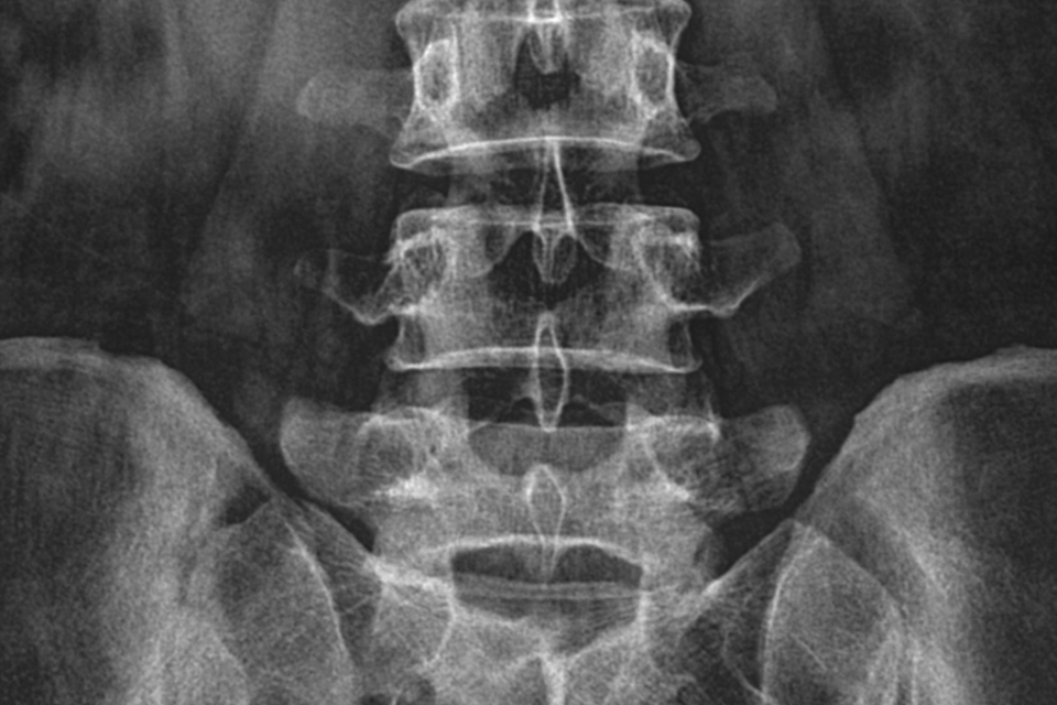 Back Injuries